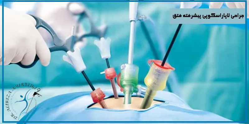 جراحی-لاپاراسکوپی-پیشرفته-فتق
