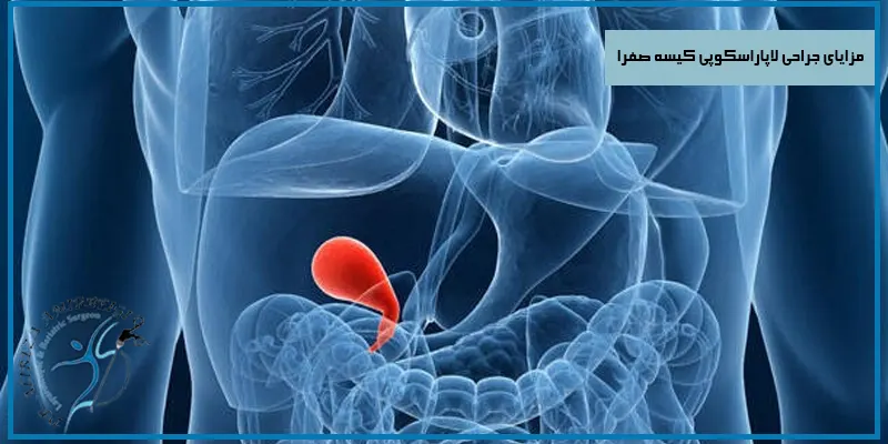 مزایای-جراحی-لاپاراسکوپی-کیسه-صفرا