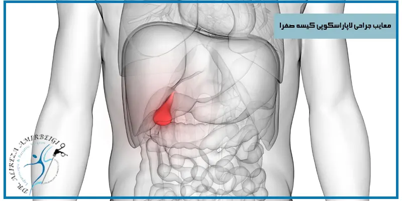 معایب-جراحی-لاپاراسکوپی-کیسه-صفرا