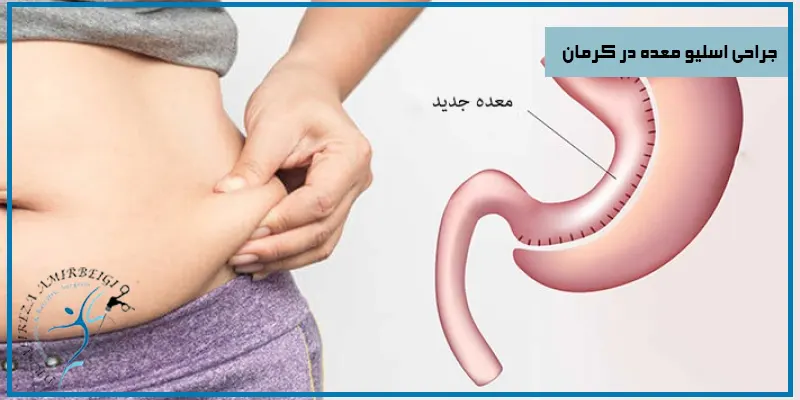 جراحی-اسلیو-معده-در-کرمان