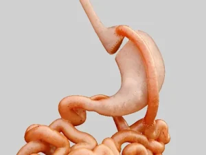 جراحی بای پس معده