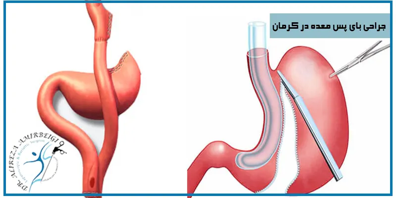 جراحی-بای-پس-معده-در-کرمان