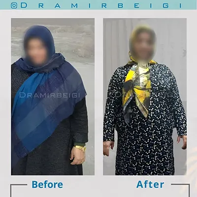 نمونه-کار-بای-پس-معده