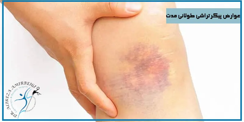 عوارض-پیکرتراشی-طولانی-مدت