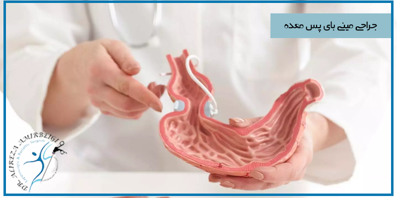 جراحی مینی بای پس معده