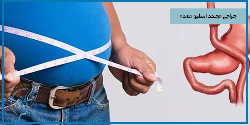 جراحی مجدد اسلیو معده