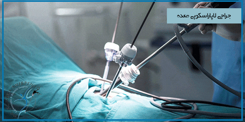میزان کاهش وزن با لاپاراسکوپی معده