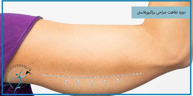 دوره نقاهت جراحی براکیوپلاستی