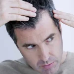 ریزش مو بعد از اسلیو معده