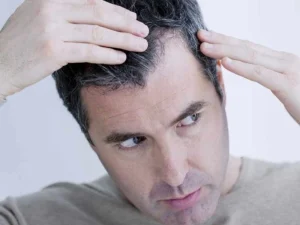ریزش مو بعد از اسلیو معده